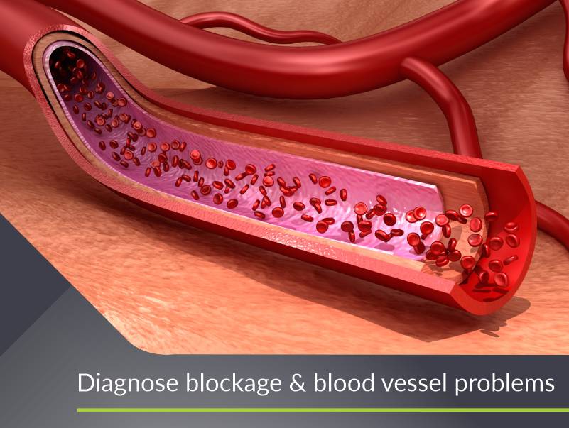 Diagnose blockage & blood vessel problems
